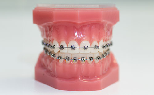 Self-Ligating Braces